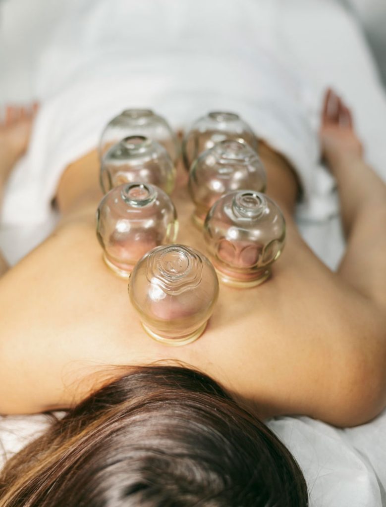 Hijama-Cupping-Therapy